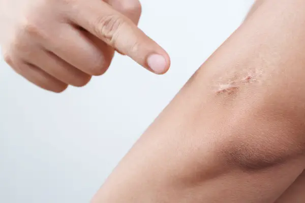 Scars Removal Treatment 