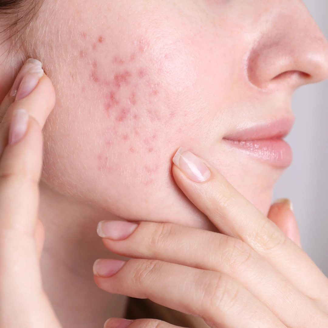 Acne Treatment 