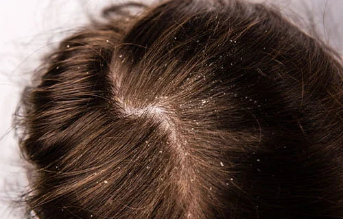 Dandruff Treatment