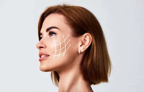 Vampire Facelift