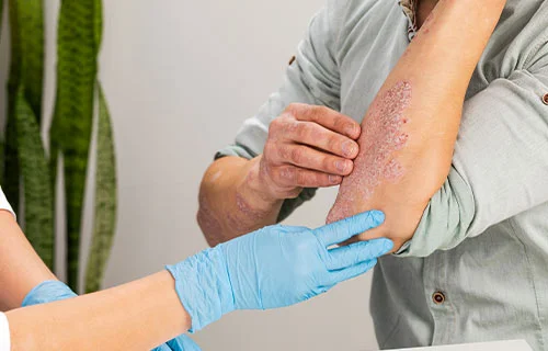 Eczema Treatment