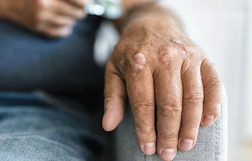 Psoriasis Treatment