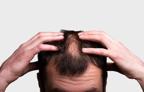 Alopecia Areata Treatment