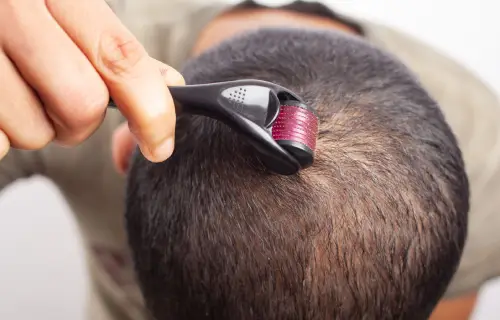 Derma roller Treatment