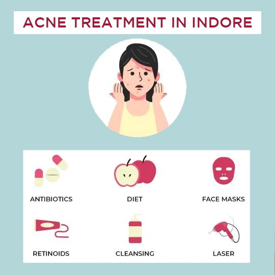 Acne Treatment - Treatments options available: Antibiotics therapy, Carbon laser peel and Laser treatment.